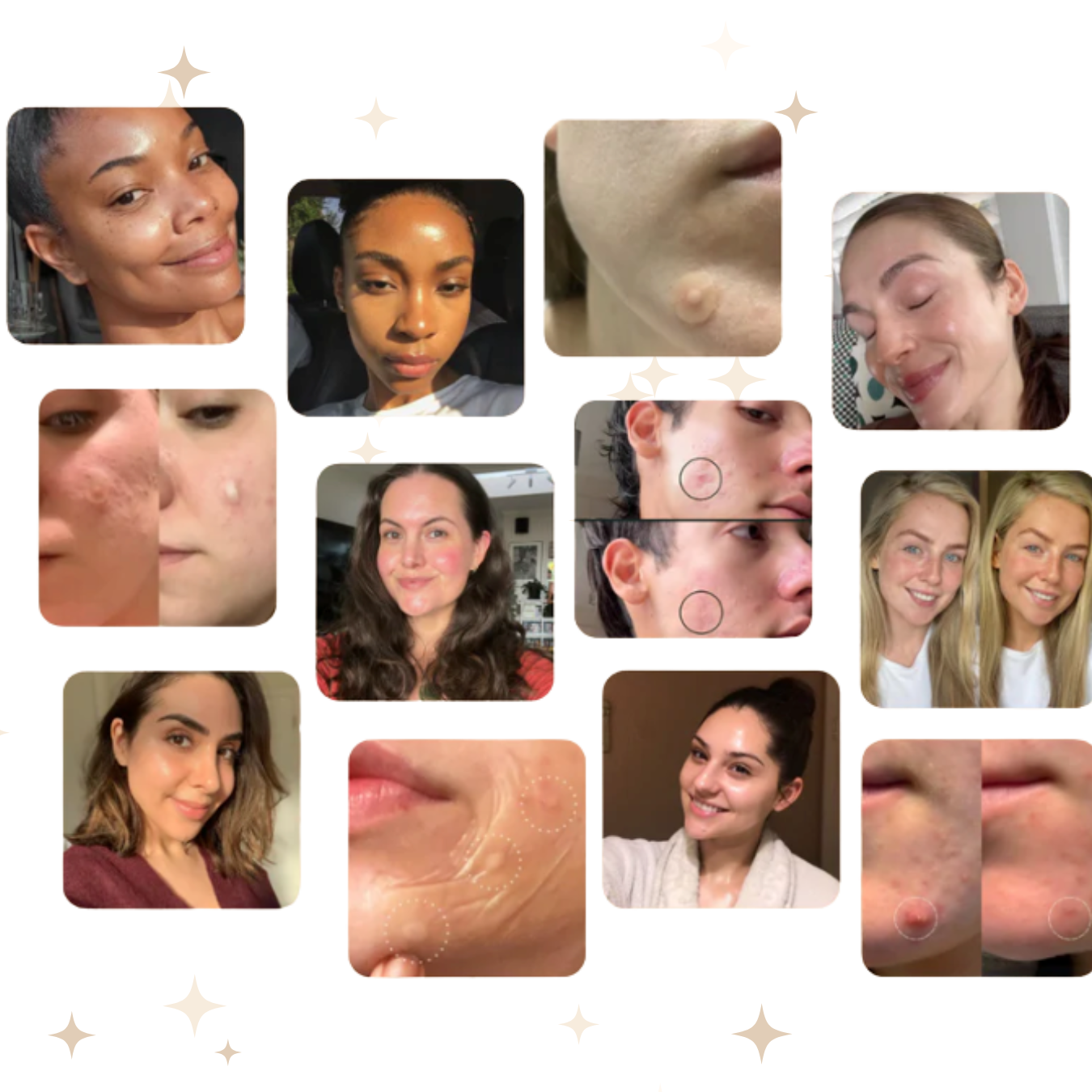 Hydrocolloid Treatment