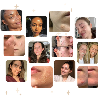 Hydrocolloid Treatment