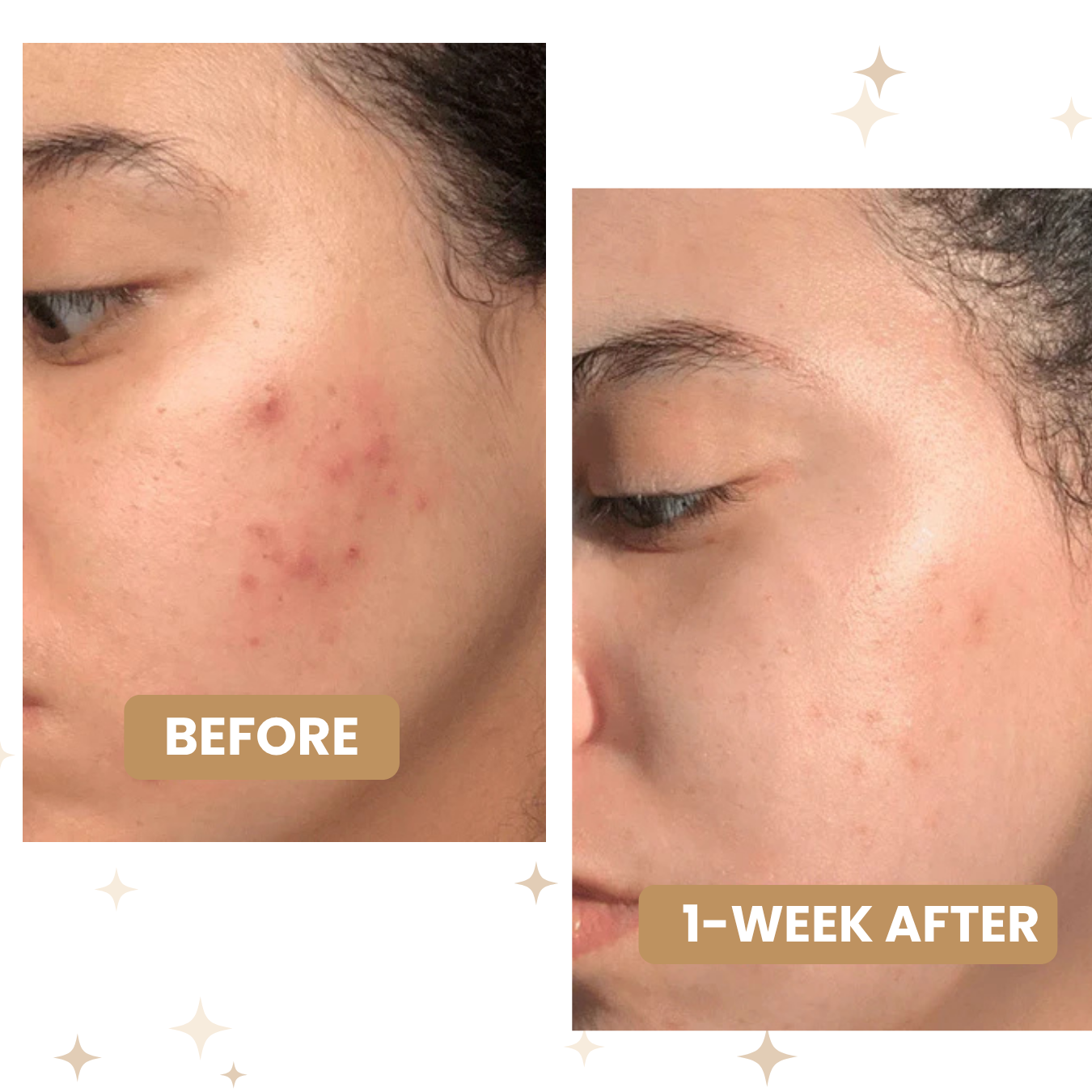 Hydrocolloid Treatment