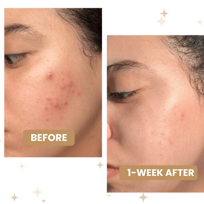 Hydrocolloid Treatment