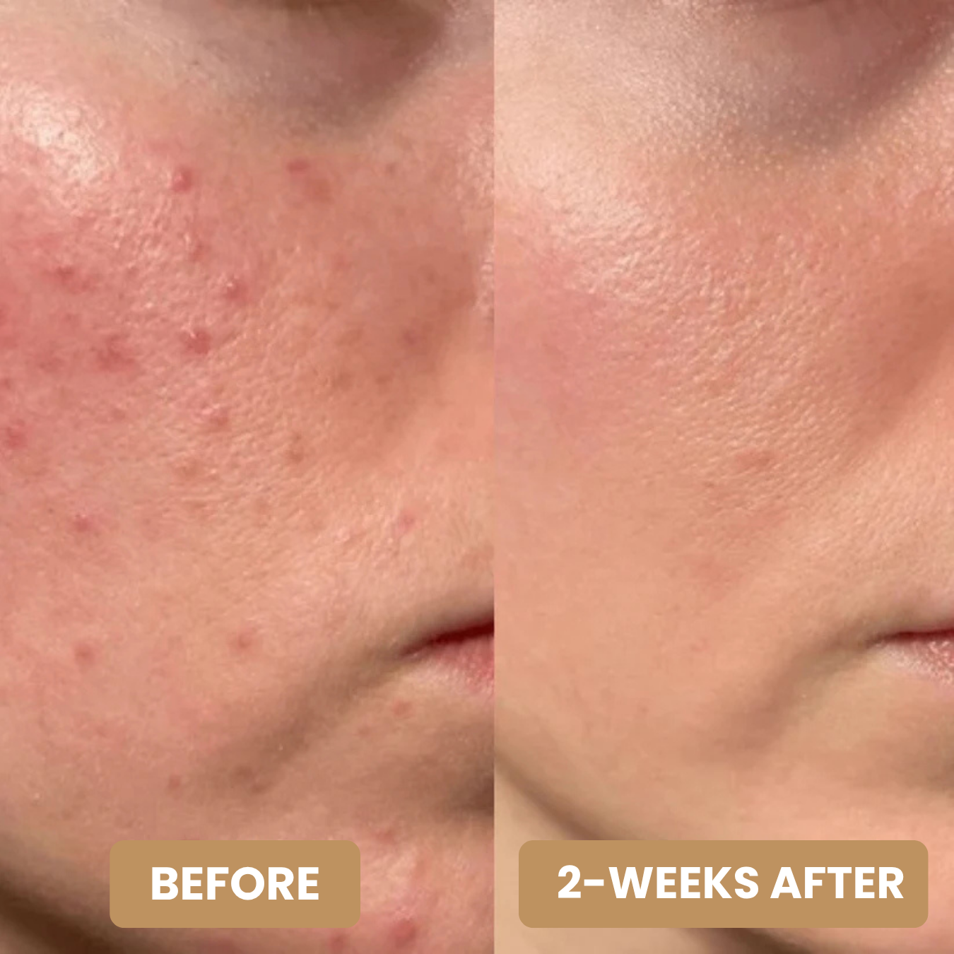 Hydrocolloid Treatment